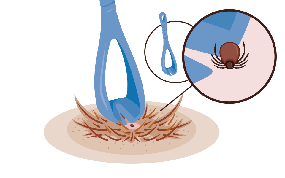 Zecken können aus dem Hundefell herausgedreht oder herausgezogen werden.